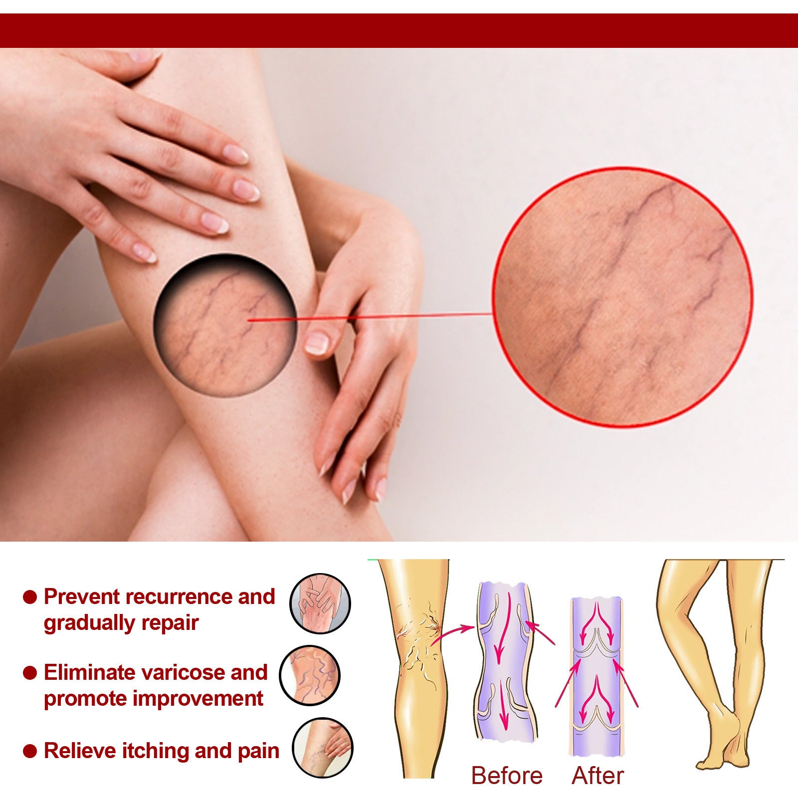 Varicose Veins Treatment Cream