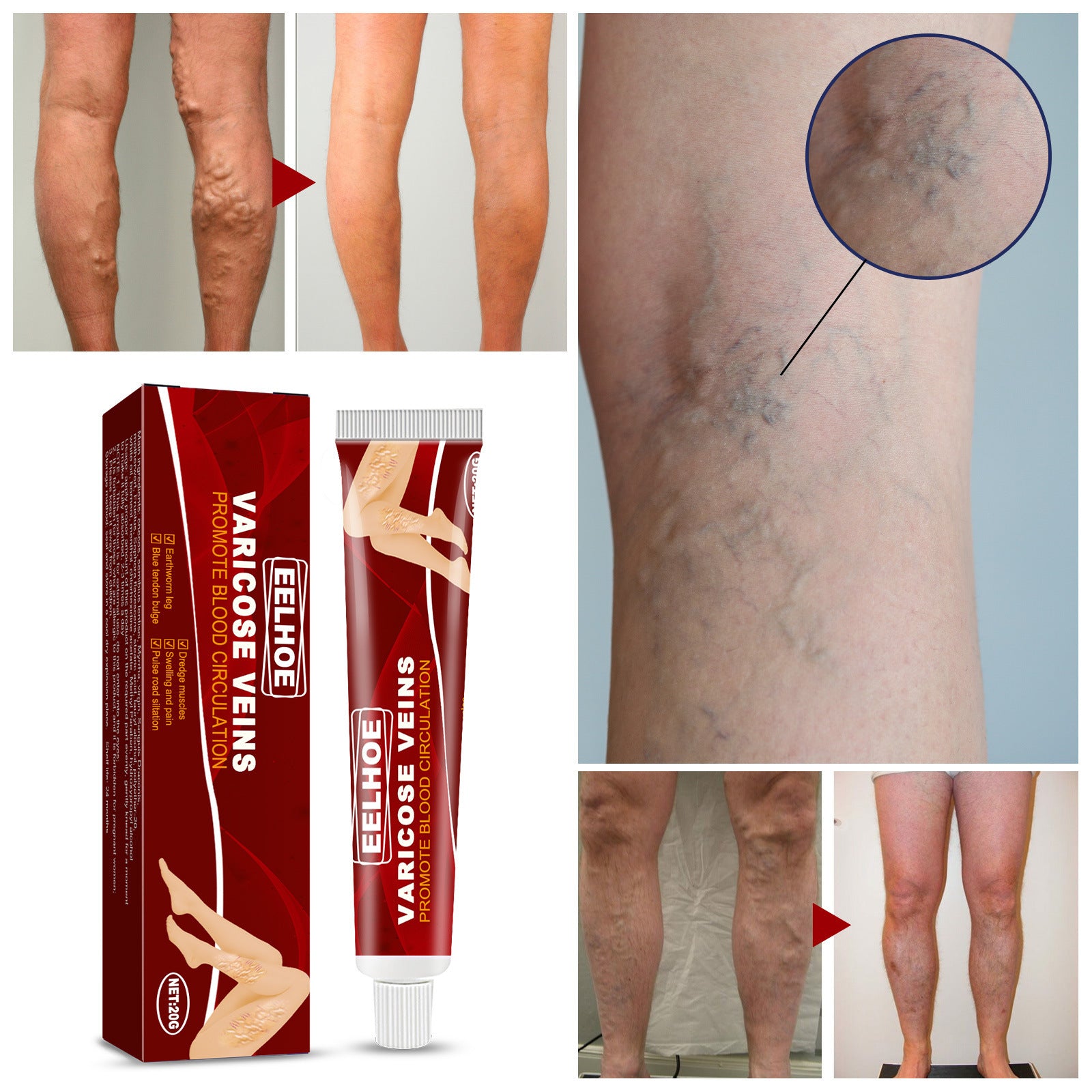Varicose Veins Treatment Cream